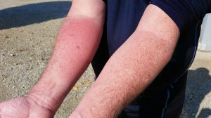 Local redness and swelling from bee sting